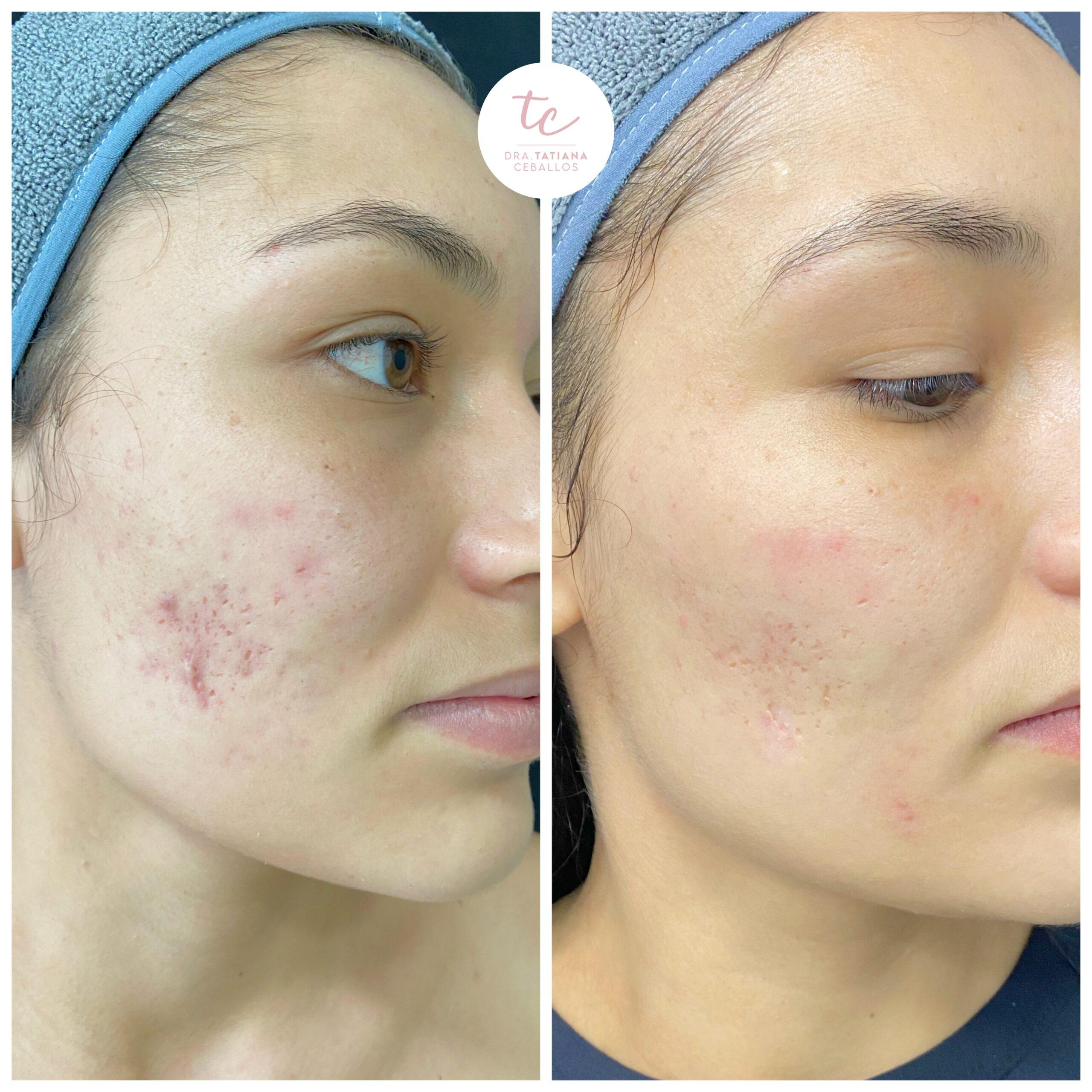 Cicatriz Tratamiento Laser Co2 Precio Láser Co2 Precio De Laser