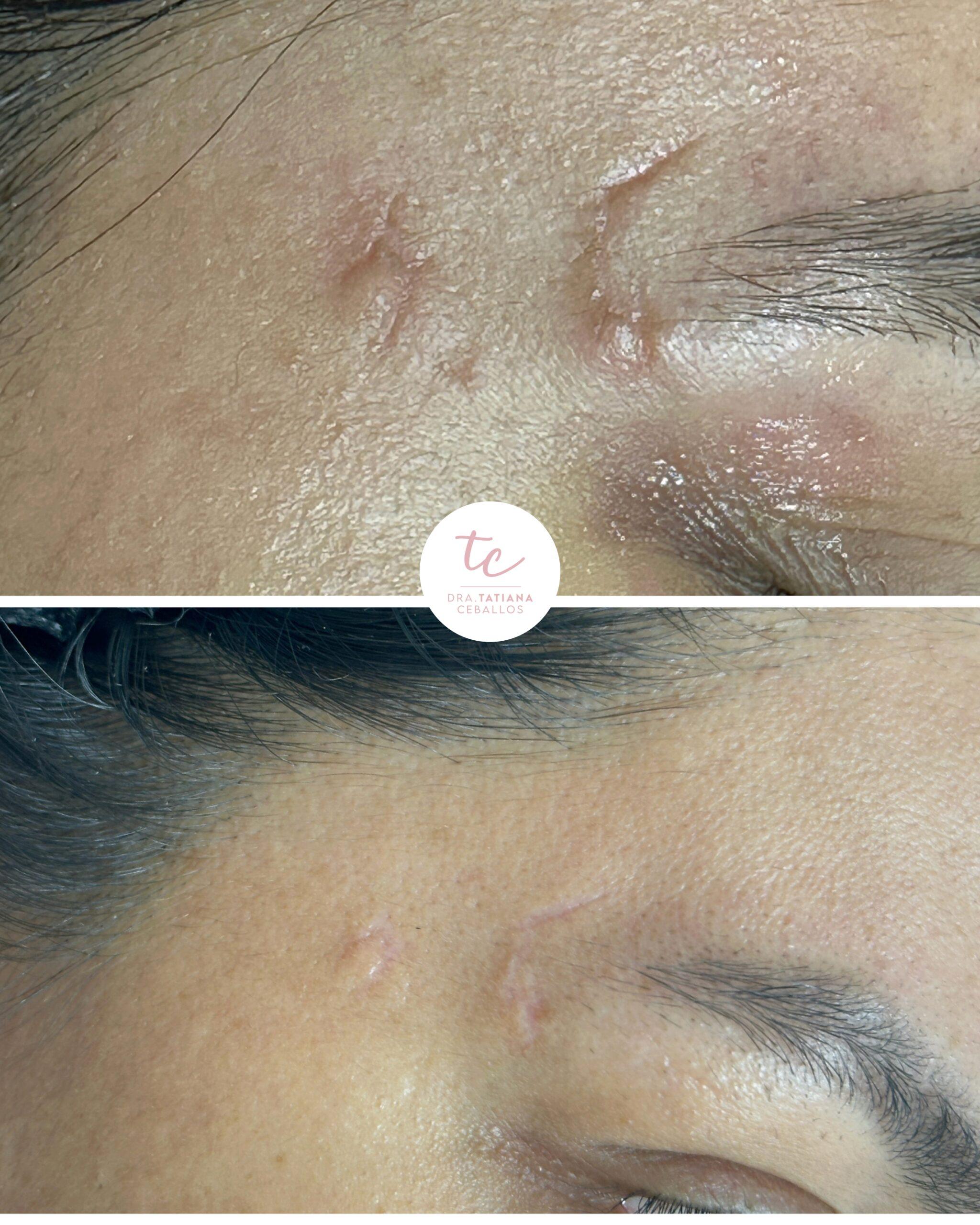Cicatrices Acne Laser Sesiones De Laser Co2 Fraccionado